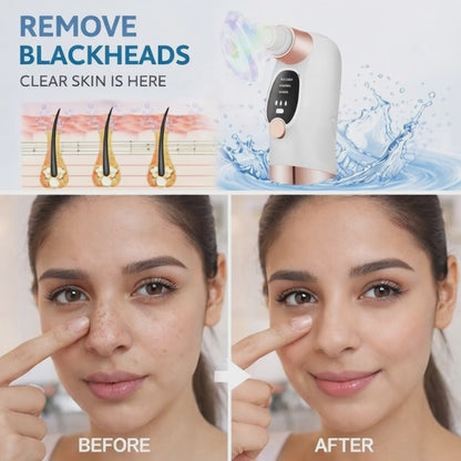 Electric Blackhead Remover for Deep Pore Cleansing & Clear Skin